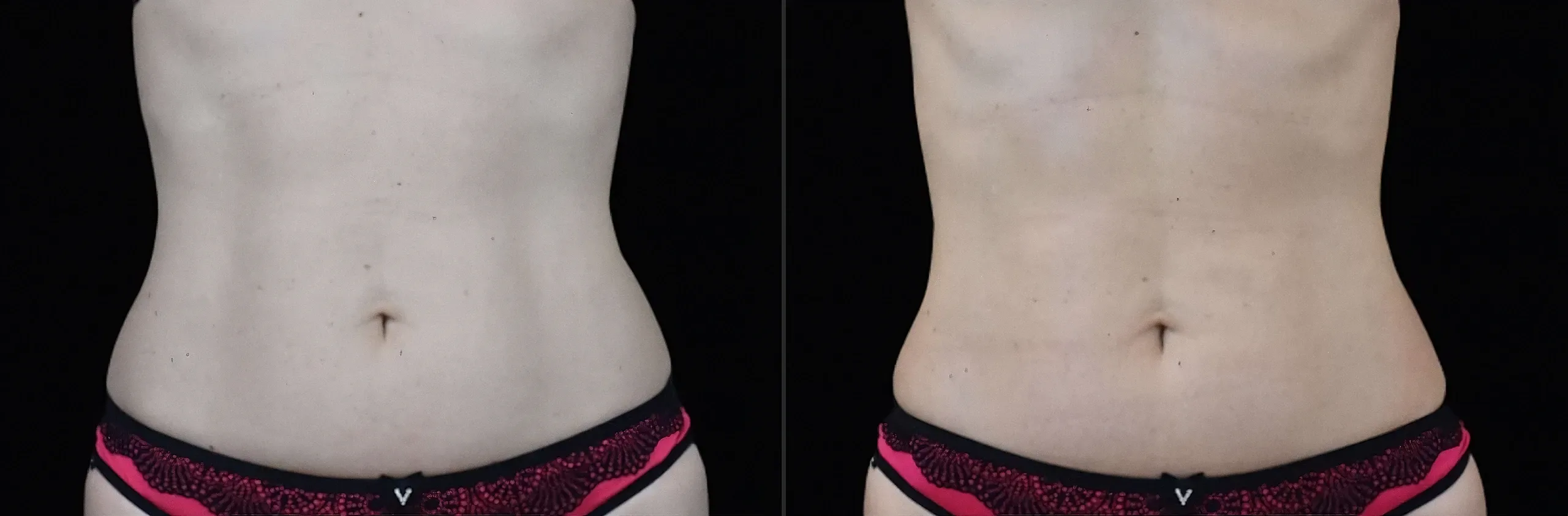 Emsculpt Neo before and after