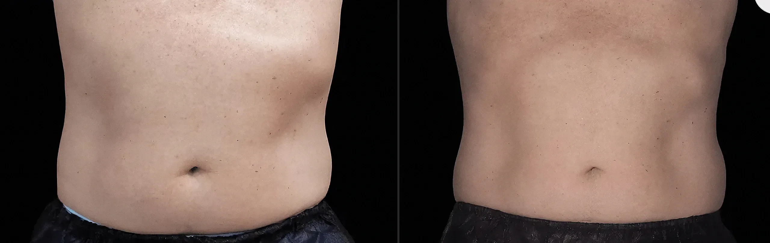Emsculpt Neo before and after